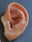 Mediprothèses-épithèse-auriculaire-de-jeune-fille