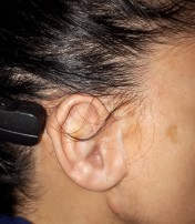 Mediprothèses-cette-jeune-femme-porte-une-épithèse-de-pavillon-d-oreille-et-un-implant-cochléaire